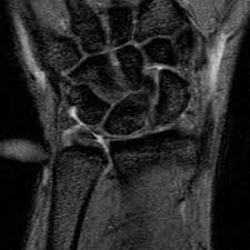 Sehnen stellen die verbindung zwischen muskeln und knochen dar. Triangular Fibrocartilage Complex Injury Radiology Reference Article Radiopaedia Org