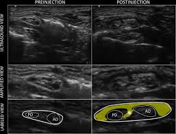 Image result for Superior Trunk Block