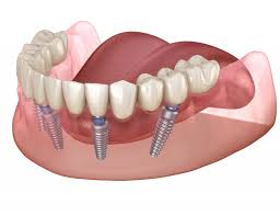 However, due to their strict eligibility rules, many veterans are not eligible for dental coverage from the va. All On 4 Dental Implants Frisco Teeth In A Day Ten Mile Dental