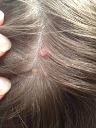 Knubbel Warzen Am Kopf Schnullerfamilie