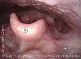 Image result for Acute Laryngitis