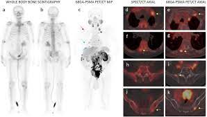 However, as with other types of cancer,. Does Bone Scintigraphy Still Have A Role In The Era Of 68 Ga Psma Pet Ct In Prostate Cancer Springerlink