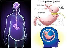 L'anneau gastrique vous est donc parfois présenté comme la solution magique qui résoudra tous vos problèmes ! Anneau Gastrique Virtuel Hypnotique C 2021