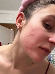How to Remove Cystic Acne Overnight