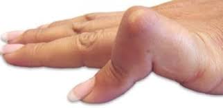 Why You Should See A Doctor For Your Jammed Finger Boutonniere Deformity Oh My Arthritis