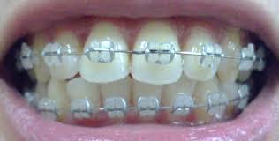 Black And White Braces Color Silver Pearly Bands Ceramic Braces Dental Braces Braces Colors