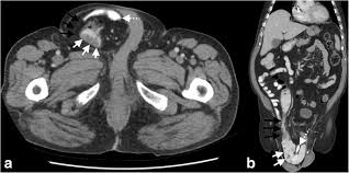 Local colon cancer symptoms affect your bathroom habits and the colon itself. A Rare Case Of Ascending Colon Adenocarcinoma Incarcerated In An Inguinoscrotal Hernia Case Report And Literature Review Surgical Case Reports Full Text