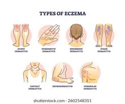 Image result for Eczema nummulare