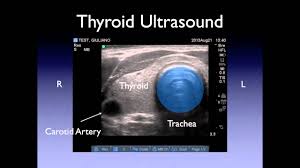 Throat cancer is often grouped into two categories: Neck Ultrasound Youtube