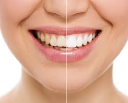 Long were the days when teeth whitening products are only available for the rich and famous. Cosmetic Dentistry Smile Analysis St Tiew Dental Group Malaysia