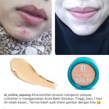 186,432 likes · 29,788 talking about this. Yang Best Pasal Acne Balm Kalau Pakai Sendayu Tinggi Hq Facebook