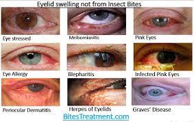 10 Causes Of Swollen Eyelids Other Than Insect Bites Bites Treatment