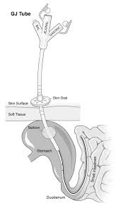 Gastrojejunostomy Tube (GJ Tube) | Treatments | Patients & Families | UW  Health
