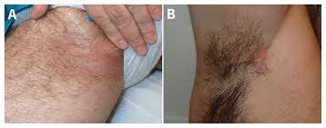 Image result for Erythrasma