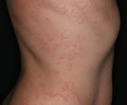 Image result for Papular urticaria