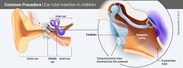 9 month old slipped underwater in the bath. Ear Tubes Surgery Placement Procedure In Toddlers Adults