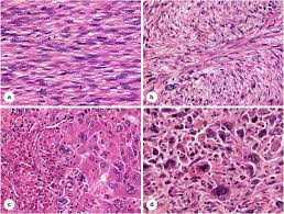 Image result for Leiomyosarcoma