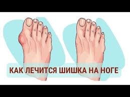 можно ли избавиться от косточки на ноге без операции Kostochki Na Noge Ischeznut Na Utro Vozmi Da Natri Ih Obychnym Youtube Podtyazhka Kozhi Naturalnaya Medicina