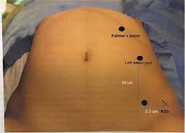 We describe a new technique using direct optical entry at this site which then allows visual inspection of the umbilicus and (if necessary) adhesiolysis to allow subsequent insertion of an. Tips And Tricks In Performing Laparoscopy Different Techniques Of Insertion Of The First Trocar Melaka Fertility