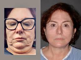 Today I saw this beautiful 65 year old patient of mine from Michigan, this  is her #plasticsurgerybefireandafter 1 year post-op and I think she looks  20 years younger!! She had a prior