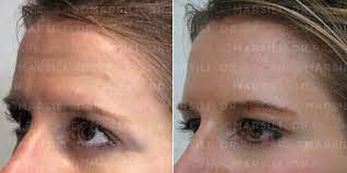 La #toxine botulique est une toxine utilisée en#esthétique du #visage comme #botox sécrétée par une bactérie. Botox Paris Injections Anti Rides