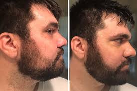 Is your beard and minoxidil the secret to make a patchy beard full? The Struggle To Grow A Beard Is Real So Men Are Faking It Wsj