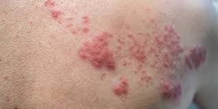 We have all the answers! The Stages Of Shingles And How The Condition Progresses