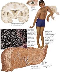 Medical illustration of Wilson disease: brain, Kayser-Fleischer ring in the eye, neurological signs, and cirrhotic liver