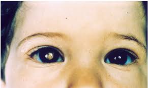 Congestion is common in babies. Camera Flashes Catch Eye Cancer In Children New York Eye Cancer Center