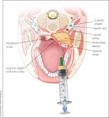 This clearly shows the growth of infection and bacteria in your mouth. Peritonsillar Abscess American Family Physician