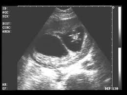 Ultrasonido De Gemelos De 3 Meses De Gestacion Imagui