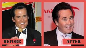 Wayne newton is a singer of both country mix and classic rock who was born in. The Risk Of Wayne Newton Plastic Surgery Plastic Surgery Before And After