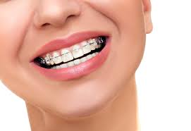 Brush your teeth with a whitening toothpaste once or twice a week while using products to promote white teeth, and use standard toothpaste for daily use. Tooth Whitening Options For People With Braces Montano Cardall Montano Elevated Orthodontics