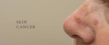 Although the percentage of cases in men is much lower than in women, male breast cancer accounts for a por. Skin Cancer Dr Juliet Williams