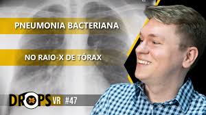 Pneumonia can be generally defined as an infection of the lung parenchyma, in which consolidation of the affected part practice essentials. Aprenda Como Identificar A Pneumonia Bacteriana No Raio X De Torax Youtube
