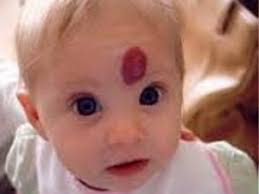 Allah swt telah menciptkan maka jika tanda lahir tersebut berupa hal yang akan membahayakan anda, seperti menyebabkan orang. Cara Menghilangkan Tanda Lahir