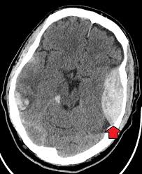 Epidural Kanama Bt Goruntusu Google Arama
