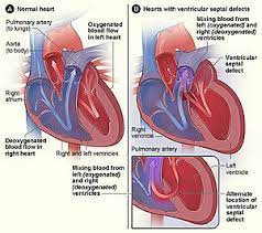 Congenital Heart Defect Wikipedia
