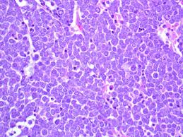 Merkel cell carcinoma (mcc) is a rare and aggressive skin cancer occurring in about 3 people per 1,000,000 members of the population. Brendan Dickson Md On Twitter Merkel Cell Carcinoma Nb Scant Cytoplasm Stippled Chromatin Brisk Mitosis Apoptosis Dot Like Ck20 Pathology