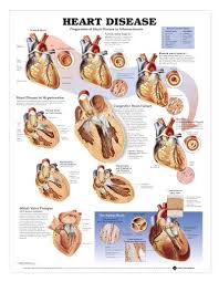 Heart Disease Chart Heart Disease Laminated Lfa 99912