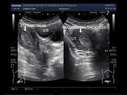 They can often be suggested on ultrasound or mri studies but may require sonohysterography or direct visualization for confirmation. Students Com
