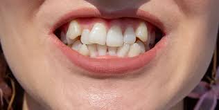 Snaggle Teeth | Tiktok