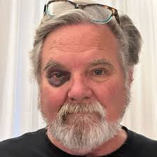 Long story, but I'll make it short I had ambulance, EMTs, triage, three x-ray  sessions, two MRIs, three doctor consults, overnight observation, meds,  saline drip…2/