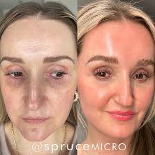 Rejuvenate Your Skin! Microneedling & Customized Skincare Specialists —  Spruce Micro 174 Heritage Parkway, Broussard, LA, USA