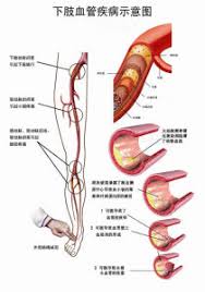 China 3d Medical Lower Limb Vascular Chart Jly Ac01