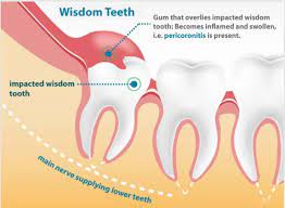 If you are noticing tenderness and bleeding in the back of your mouth next to your molars, it could be a sign of your wisdom tooth coming in. How Do You Make Wisdom Tooth Pain Go Away Complete Dental Care
