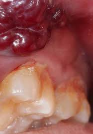 The most common early symptom of tongue cancer is a sore on your tongue. Management Strategies For Oral Cancer Subsites Intechopen