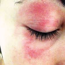 My Skin Allergy Methylisothiazolinone Mi And Methylchloroisothiazolinone Mci Skin Allergies Allergies Sensitive Skin Care