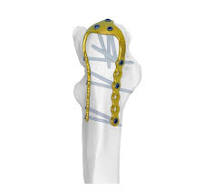 Olecranon U-Locking Plate,Medical Device Manufacturers ...