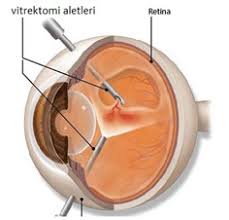 goz ici kanamalari prof dr gokhan gulkilik